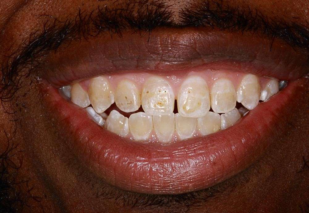 Crowns-and-Invisalign-case1-part3 Crowns-and-Invisalign-case1-part3