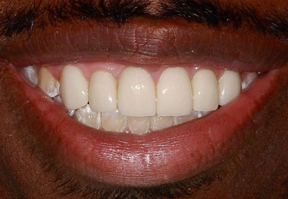 Crowns-and-Invisalign-case1-part4
