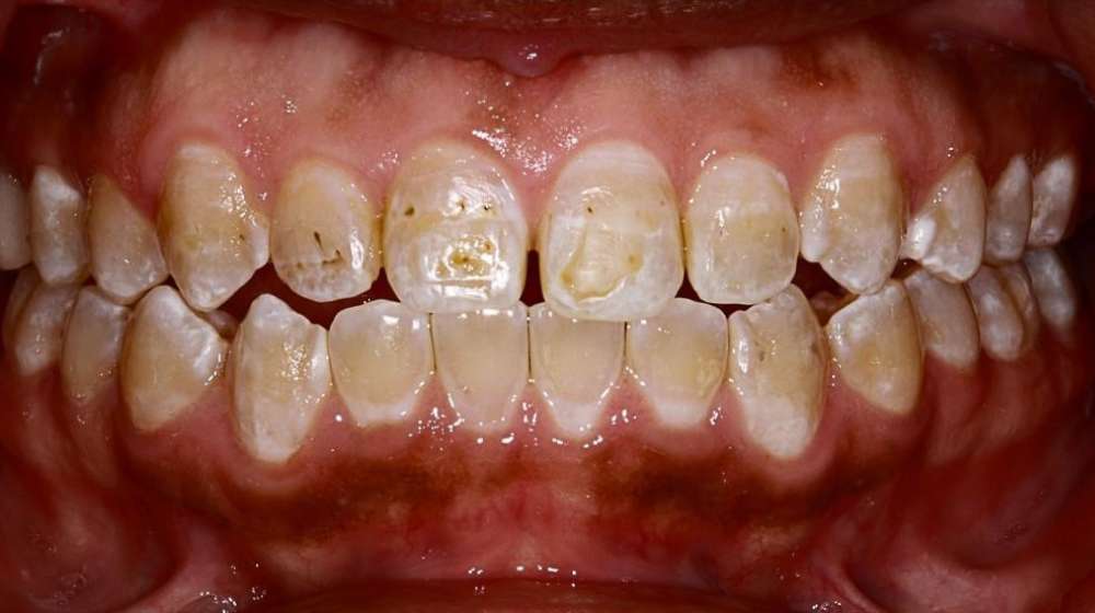 Crowns-and-Invisalign-case2-part1 Crowns-and-Invisalign-case2-part1