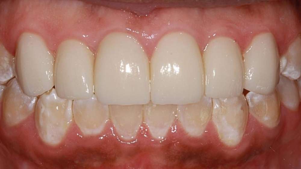 Crowns-and-Invisalign-case2-part2