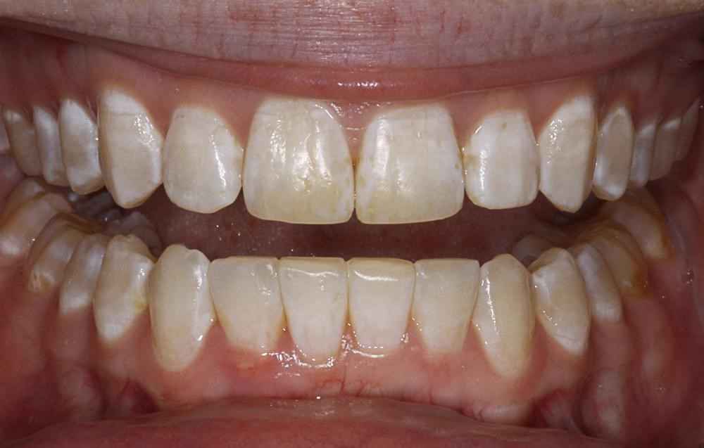 Invisalign-Before-After-10