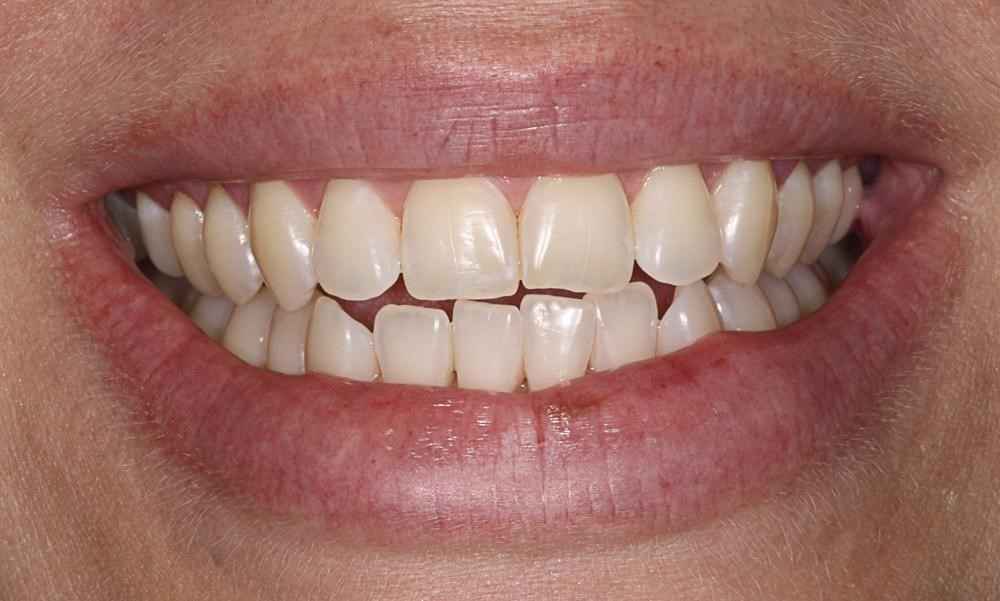 Invisalign-Before-After-11 Invisalign-Before-After-11