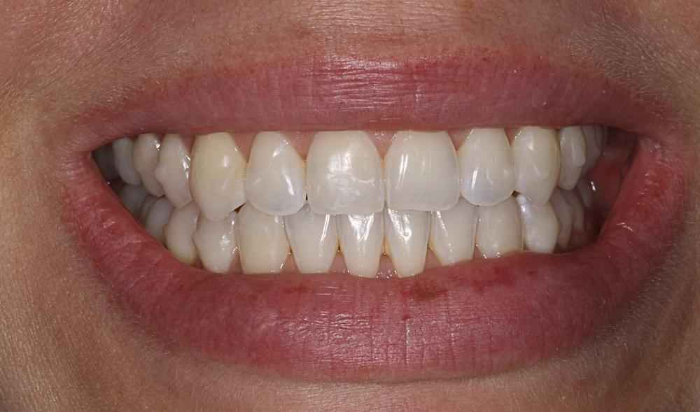 Invisalign-Before-After-12