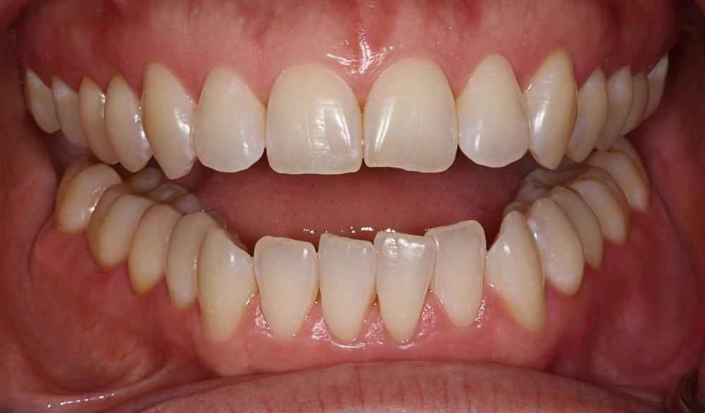Invisalign-Before-After-13 Invisalign-Before-After-13