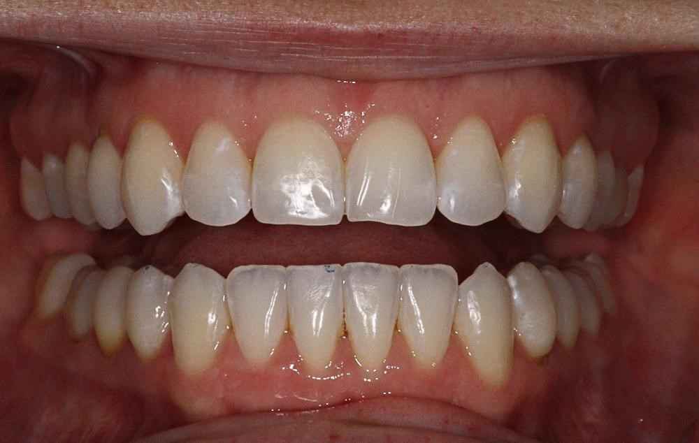 Invisalign-Before-After-14