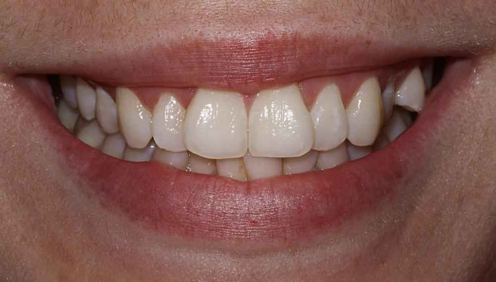 Invisalign-Before-After-15