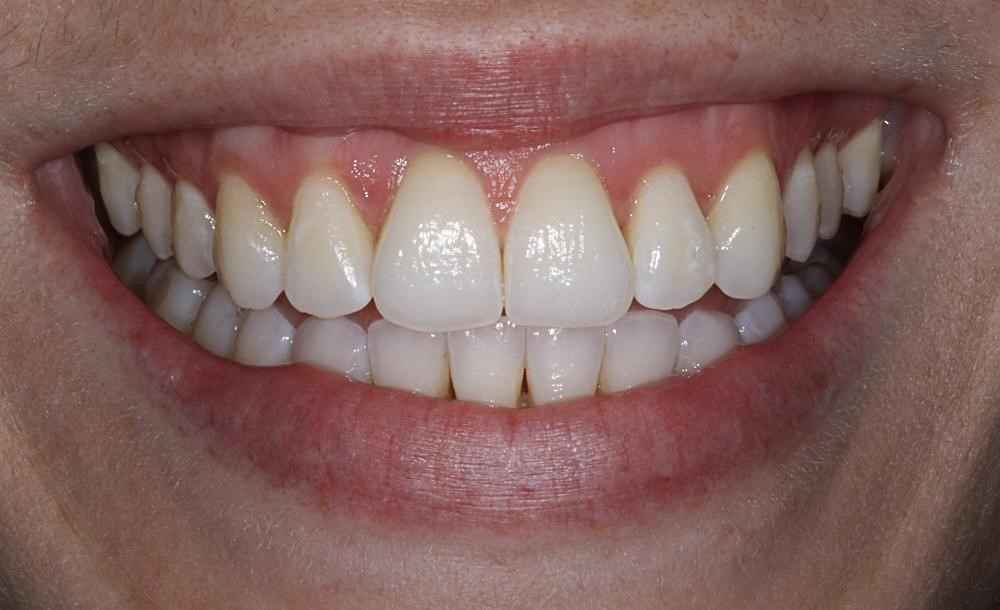 Invisalign-Before-After-16 Invisalign-Before-After-16