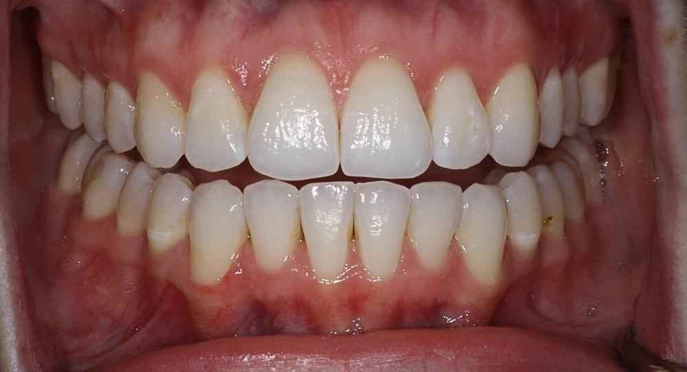 Invisalign-Before-After-18 (1)