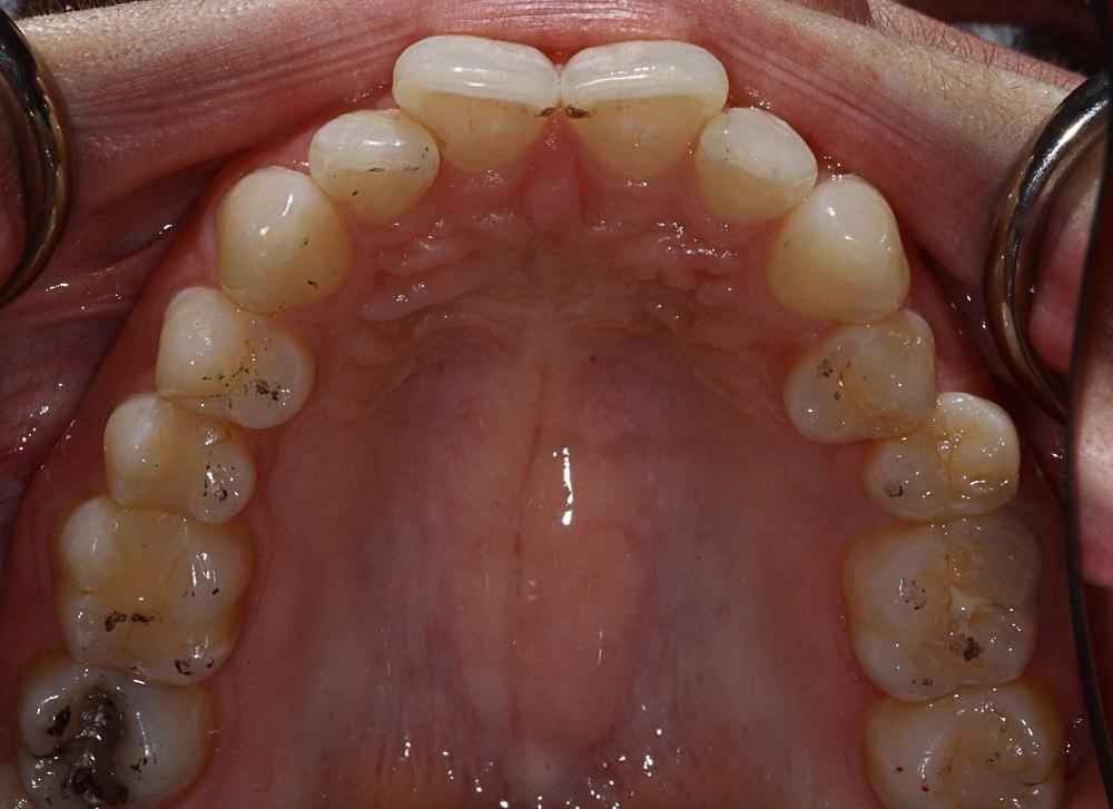 Invisalign-Before-After-19 Invisalign-Before-After-19