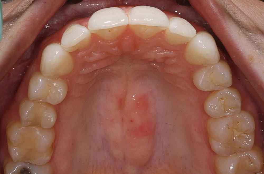 Invisalign-Before-After-20