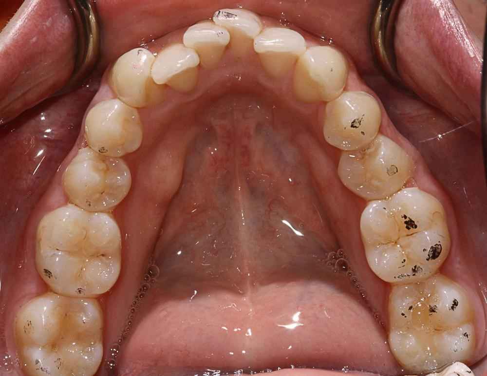 Invisalign-Before-After-21 (1) Invisalign-Before-After-21 (1)