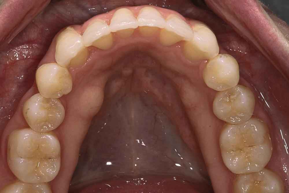 Invisalign-Before-After-22 (1)
