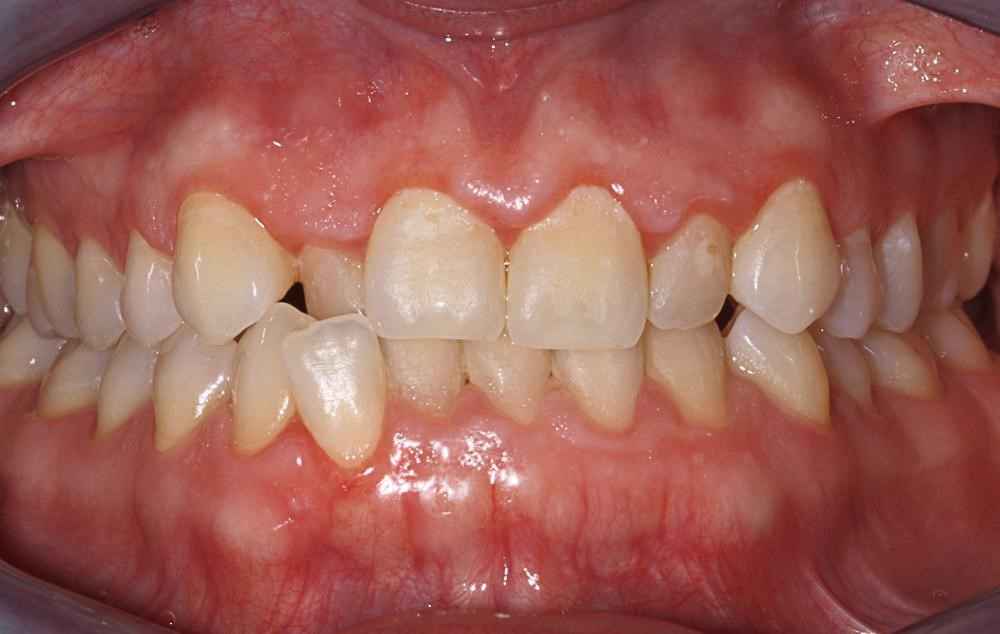 Invisalign-Before-After-25 Invisalign-Before-After-25