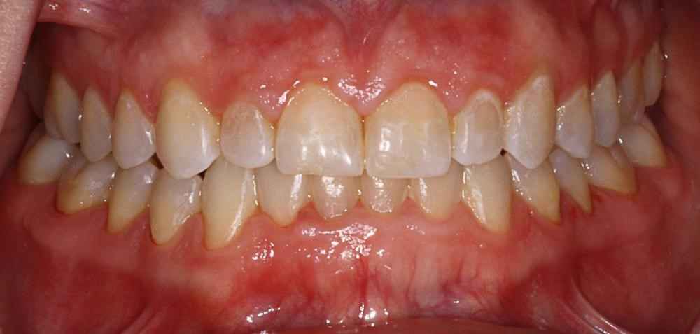Invisalign-Before-After-26
