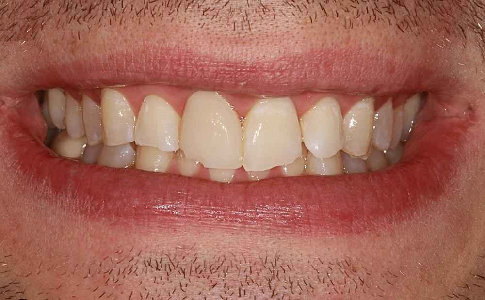 Invisalign-Before-After-27 Invisalign-Before-After-27