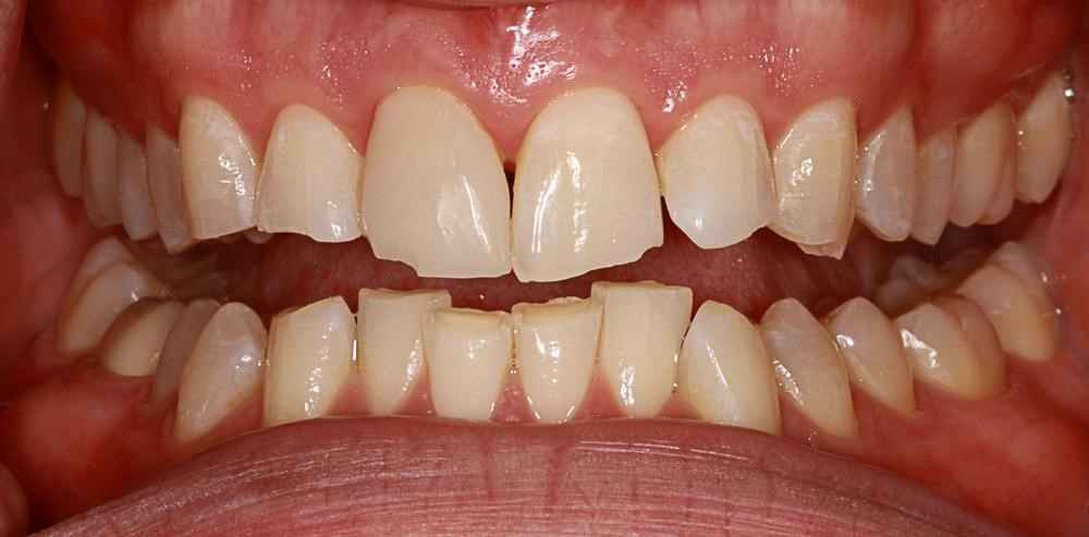 Invisalign-Before-After-31 Invisalign-Before-After-31