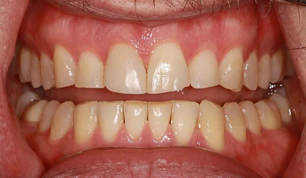 Invisalign-Before-After-32