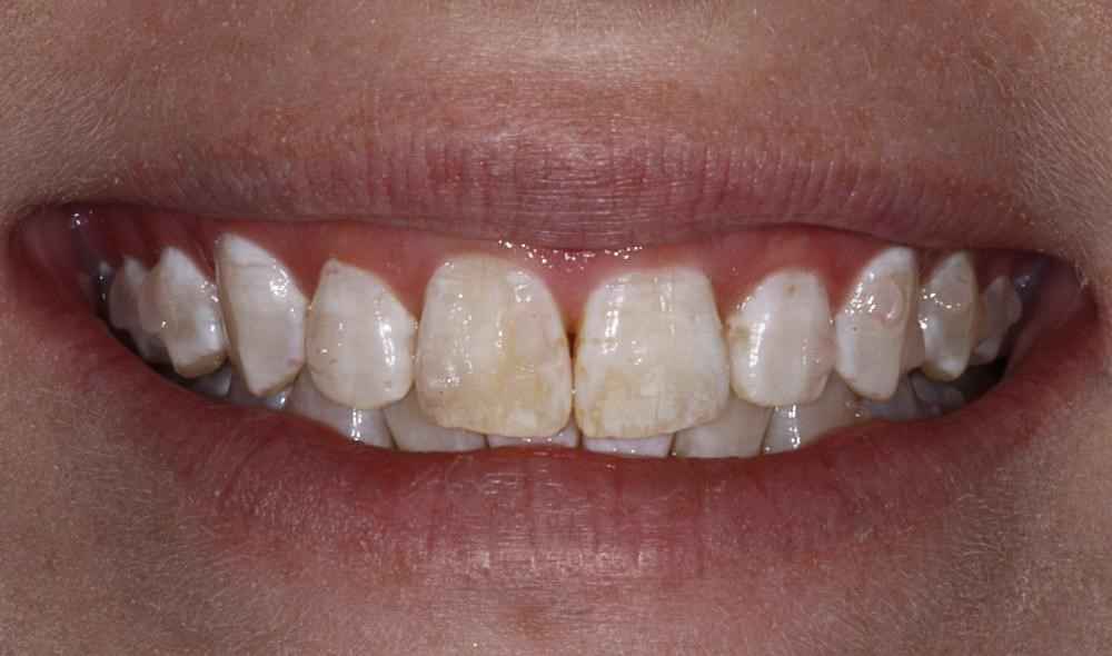 Invisalign-Before-After-7 Invisalign-Before-After-7