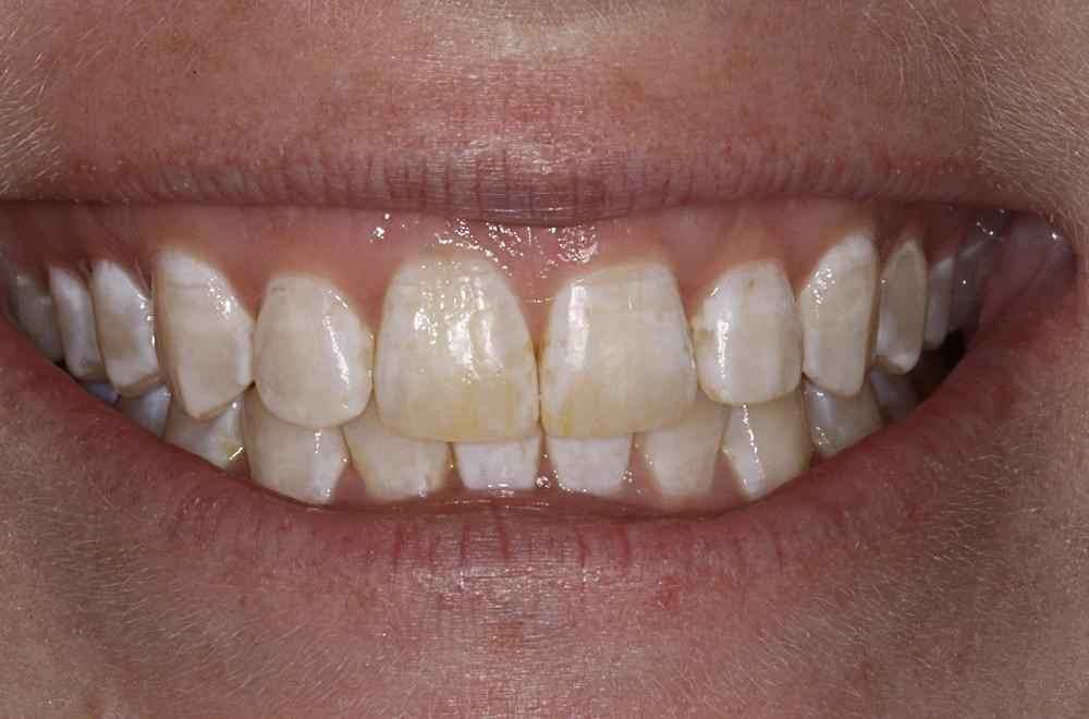 Invisalign-Before-After-8