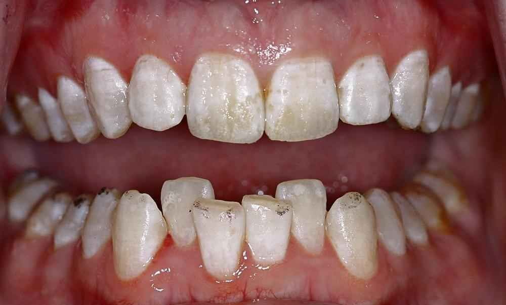 Invisalign-Before-After-9 Invisalign-Before-After-9