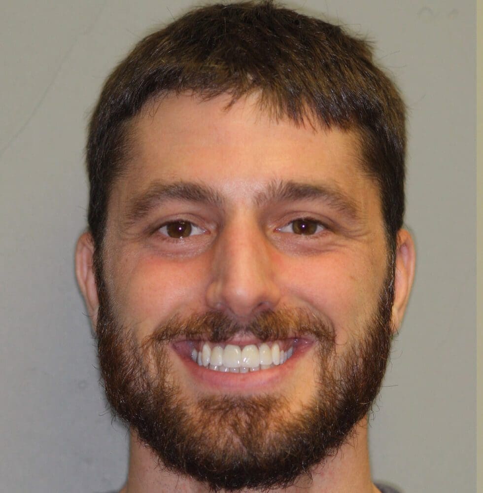 invisalign-bna-case-18-after