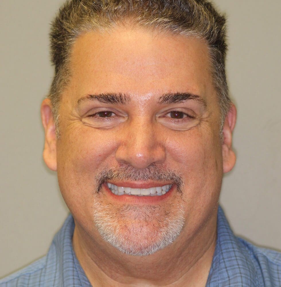 invisalign-bna-case-19-after