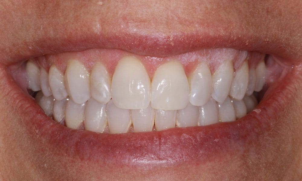 invisalign-case-10-after-image