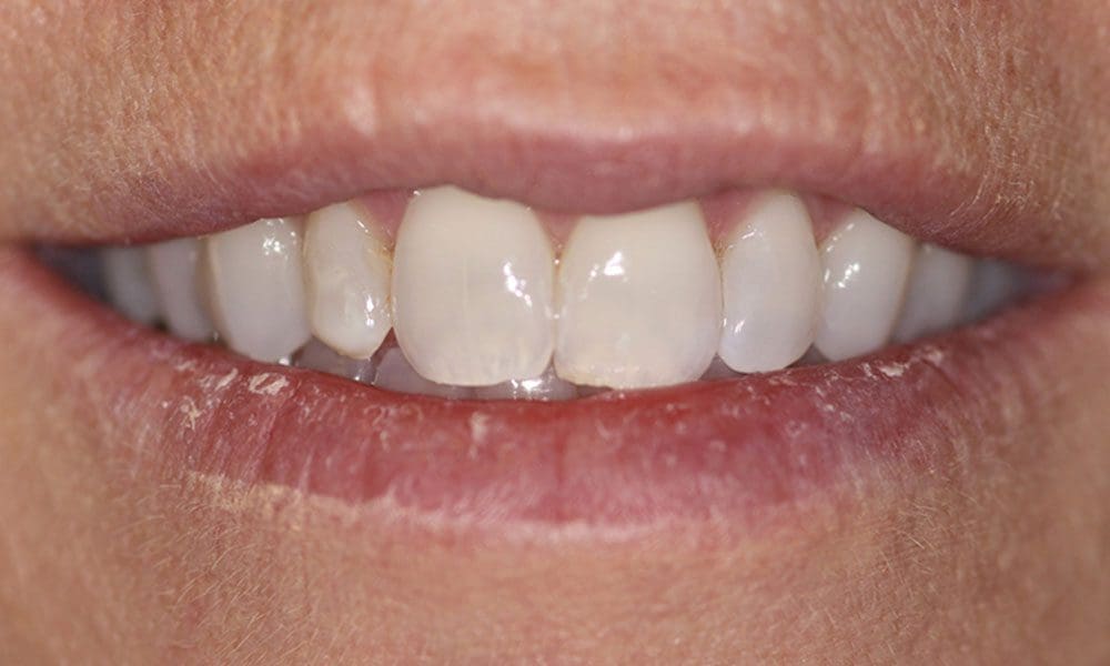 invisalign-case-10-before-image invisalign-case-10-before-image