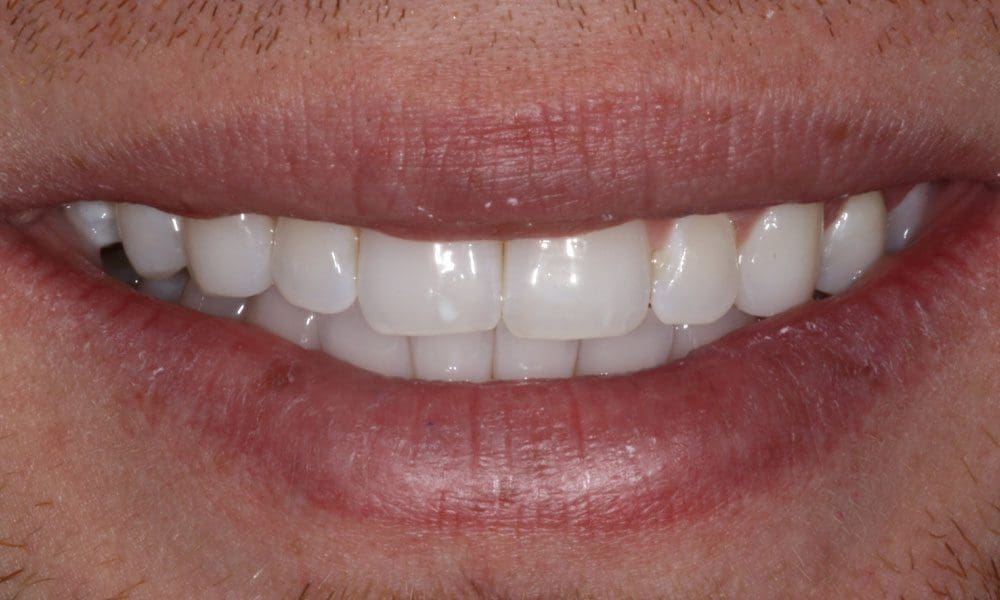 invisalign-case-11-after-image-2