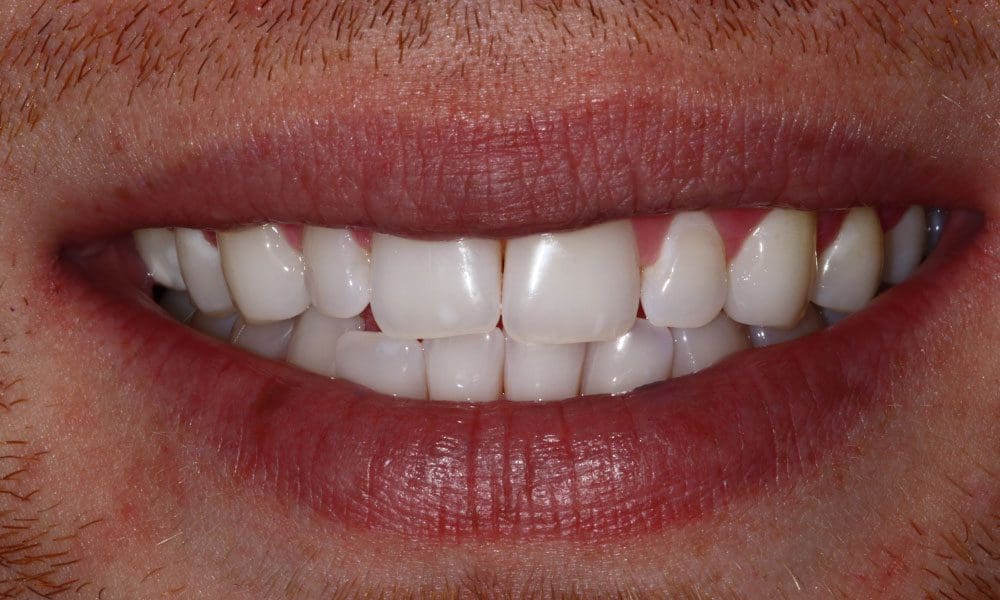 invisalign-case-11-before-image-2 invisalign-case-11-before-image-2