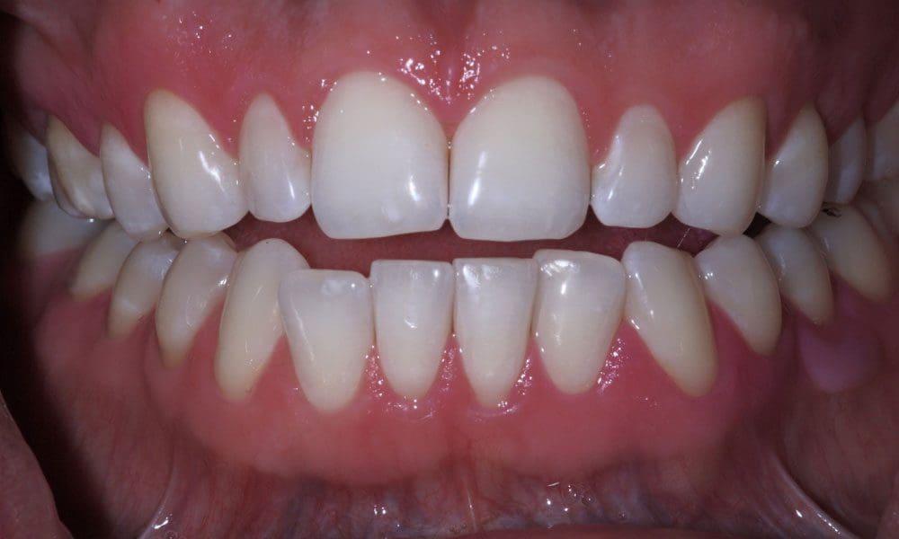 invisalign-case-11-before-image invisalign-case-11-before-image