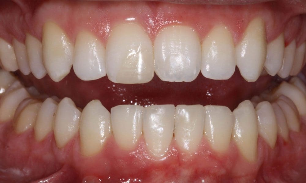 invisalign-case-12-after-image-2