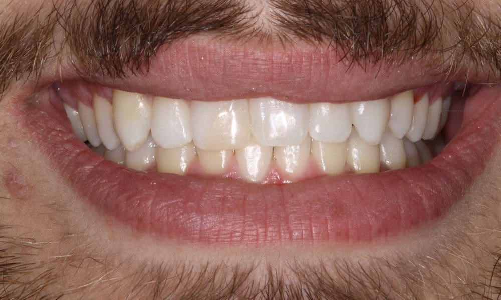 invisalign-case-12-after-image
