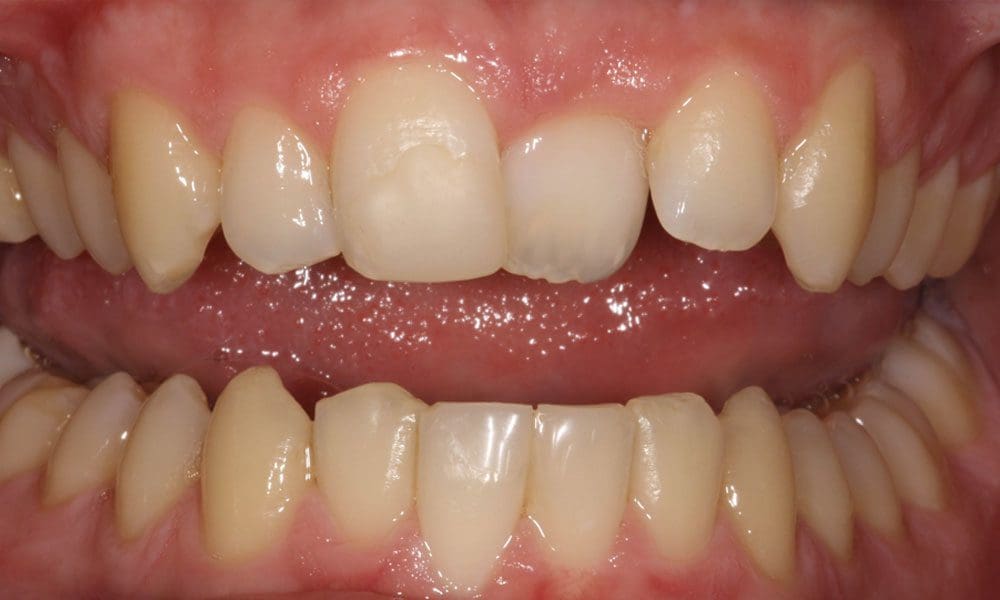 invisalign-case-12-before-image-2 invisalign-case-12-before-image-2