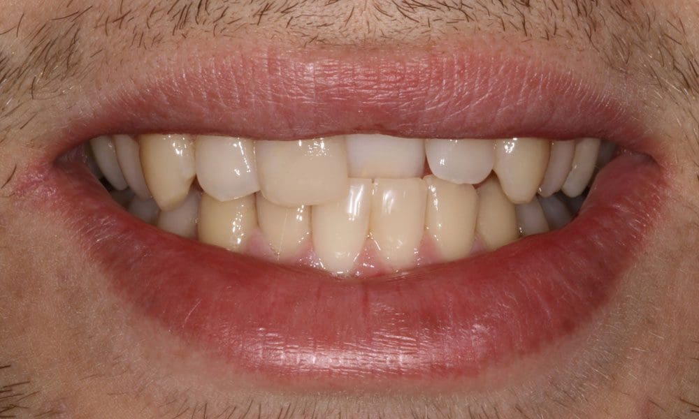 invisalign-case-12-before-image invisalign-case-12-before-image