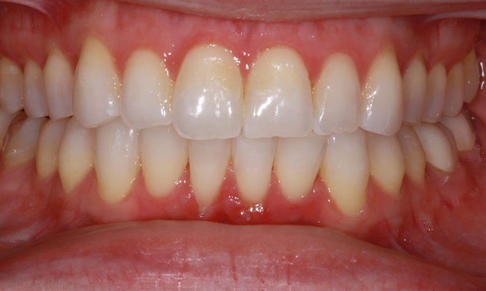 invisalign-case-13-after-image-2