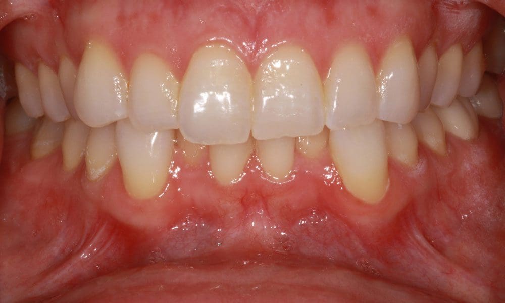 invisalign-case-13-before-image-2