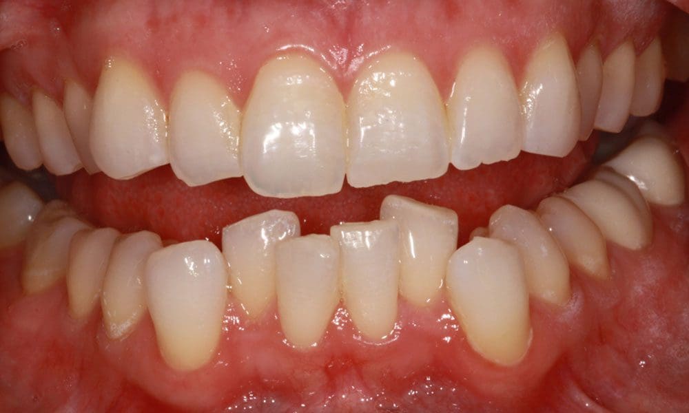 invisalign-case-13-before-image invisalign-case-13-before-image