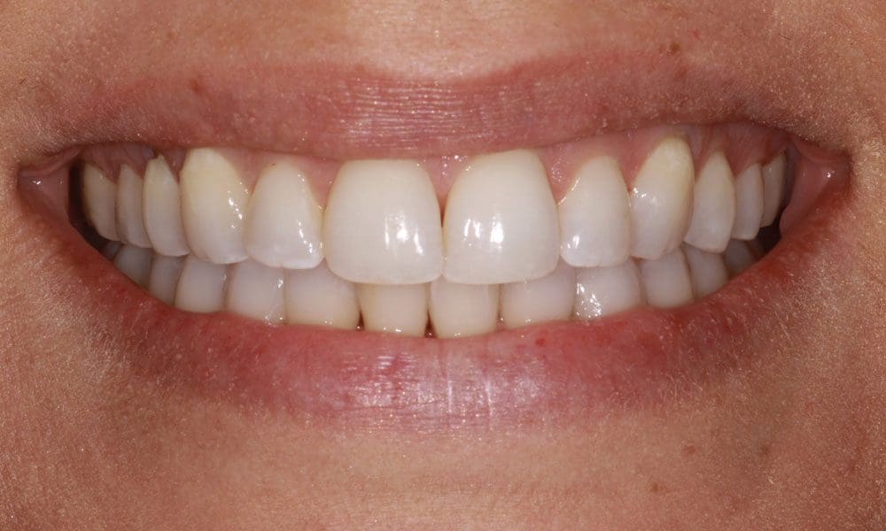 invisalign-case-14-after-image-2