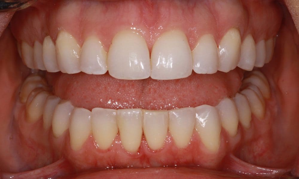 invisalign-case-14-after-image