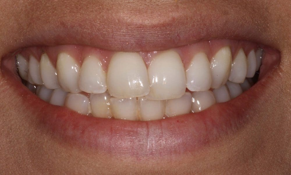invisalign-case-14-before-image-2 invisalign-case-14-before-image-2