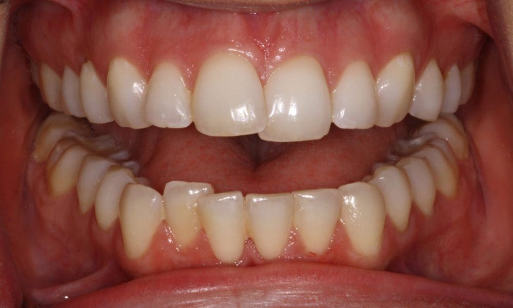 invisalign-case-14-before-image invisalign-case-14-before-image