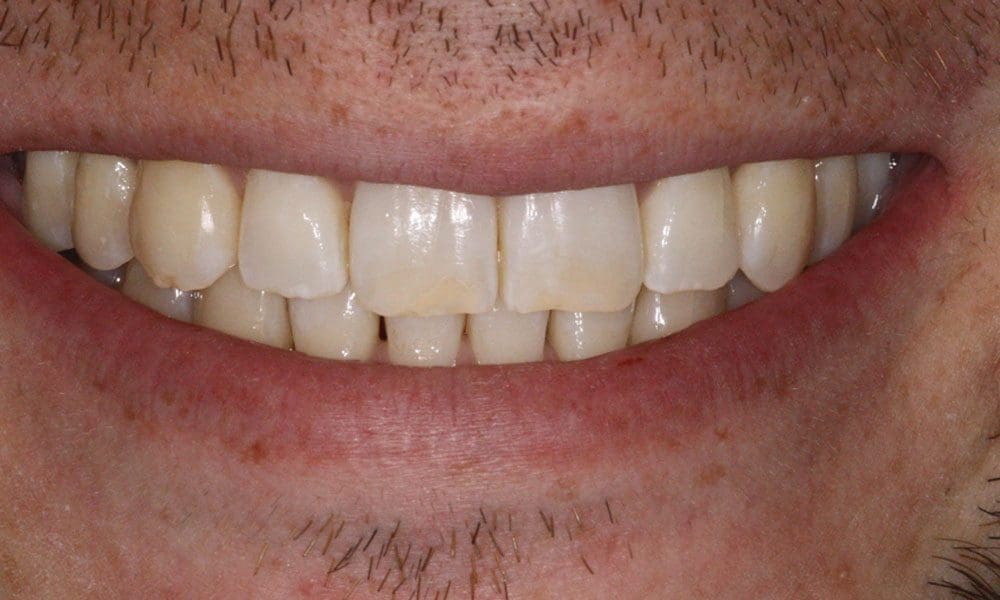 invisalign-case-15-after-image-2
