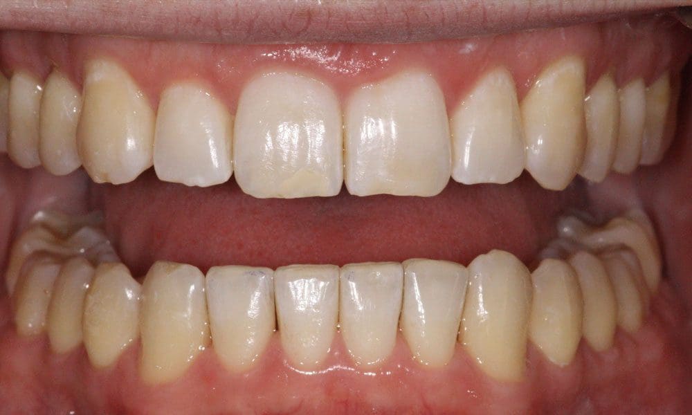 invisalign-case-15-after-image