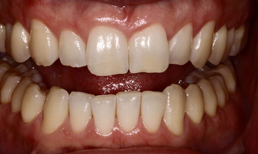 invisalign-case-15-before-image invisalign-case-15-before-image