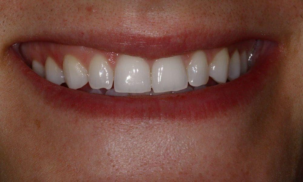 invisalign-case-16-after-image-2