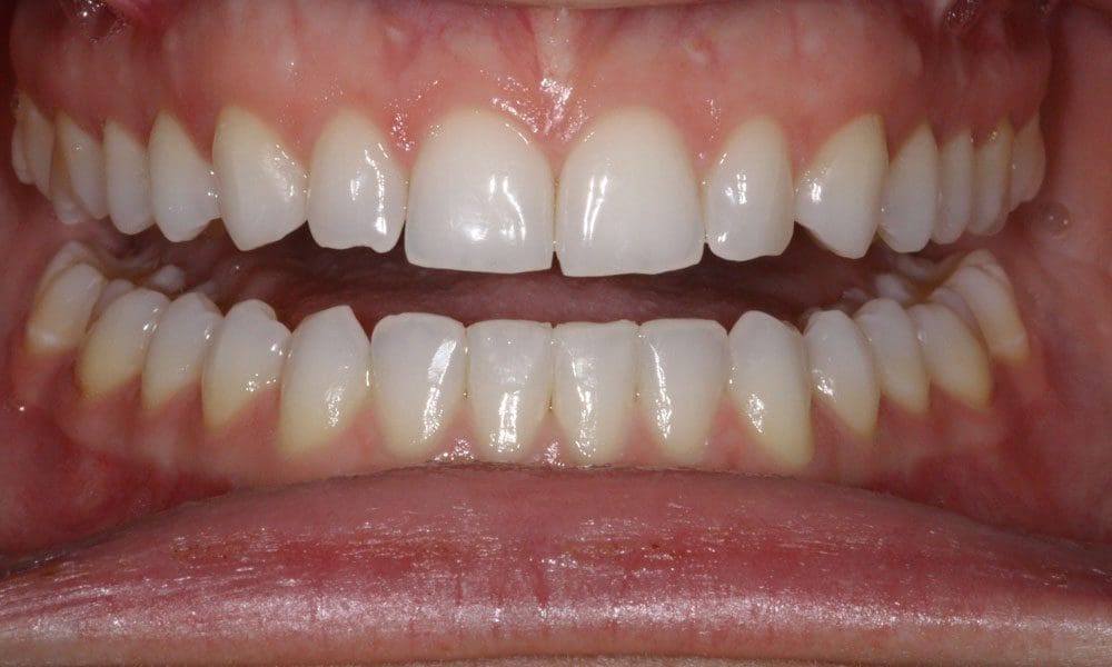 invisalign-case-16-after-image