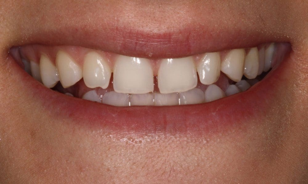 invisalign-case-16-before-image-2 invisalign-case-16-before-image-2