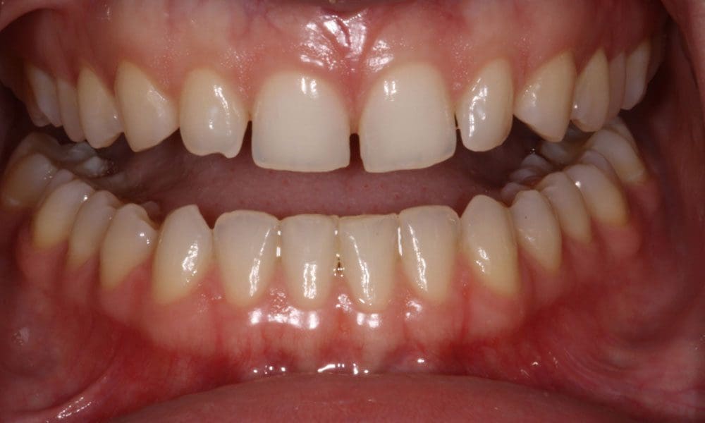 invisalign-case-16-before-image invisalign-case-16-before-image