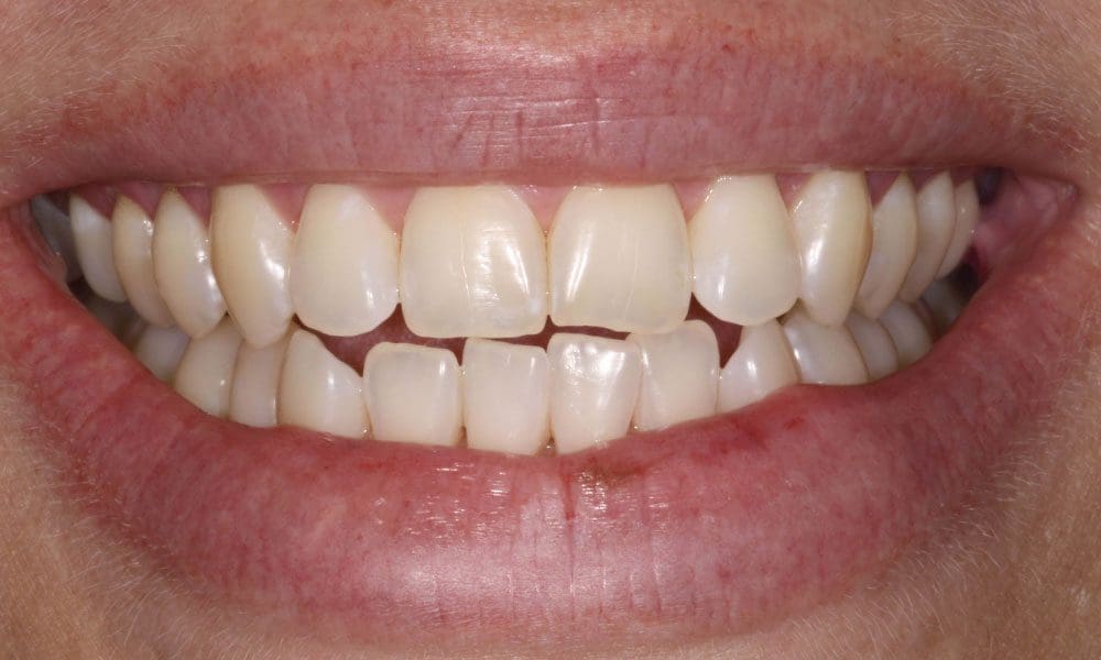 invisalign-case-17-after-image-2 invisalign-case-17-after-image-2